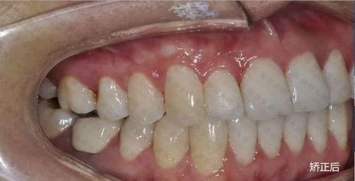 真人牙齿照片,从真人牙齿照片看口腔健康与美丽