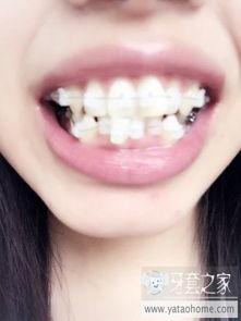 换牙的照片,见证成长的珍贵瞬间